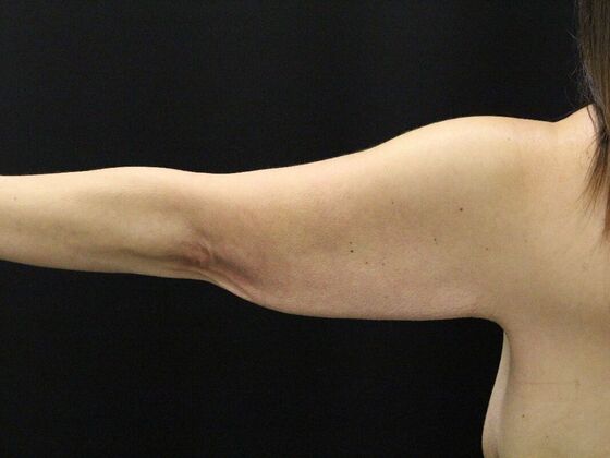 Arm Lift & Reduction: Case 14 - Before