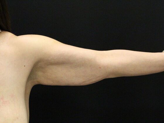 Arm Lift & Reduction: Case 14 - Before