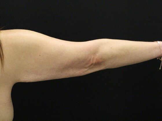 Arm Lift & Reduction: Case 14 - Before