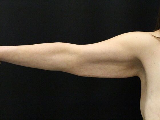 Arm Lift & Reduction: Case 14 - Before