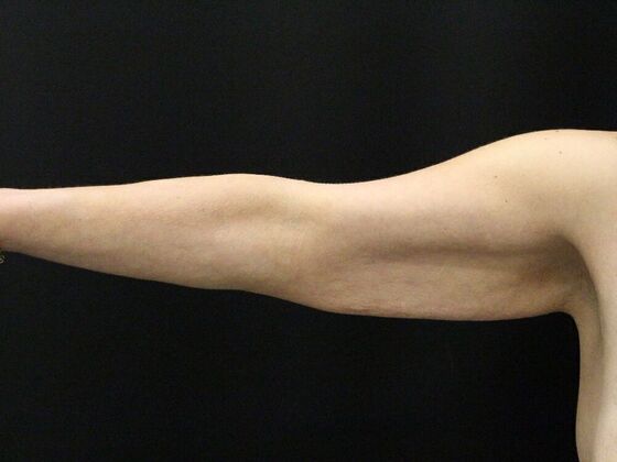Arm Lift & Reduction: Case 14 - Before