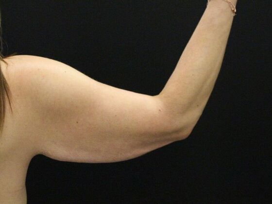 Arm Lift & Reduction: Case 14 - Before