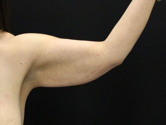 Arm Lift & Reduction Case 14 - Before