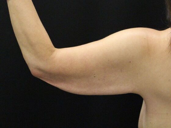 Arm Lift & Reduction: Case 14 - Before