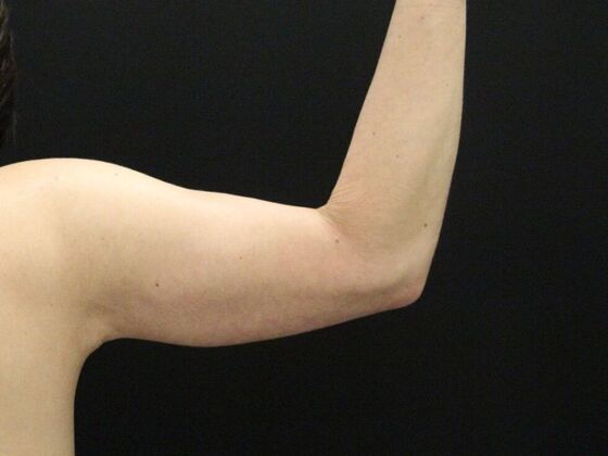 Arm Lift & Reduction: Case 14 - After