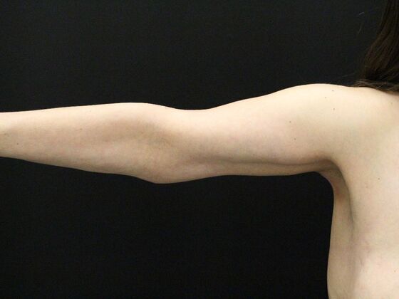 Arm Lift & Reduction: Case 14 - After