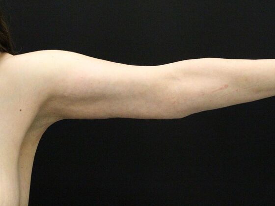 Arm Lift & Reduction: Case 14 - After