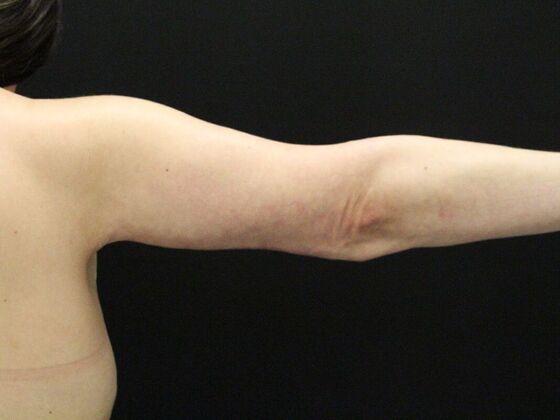 Arm Lift & Reduction: Case 14 - After