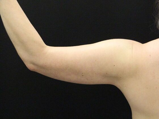 Arm Lift & Reduction: Case 14 - After