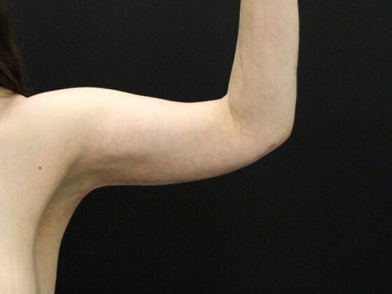 Arm Lift & Reduction Case 14 - After