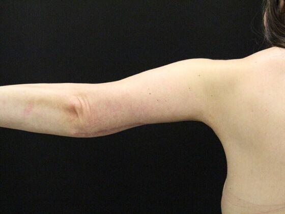 Arm Lift & Reduction: Case 14 - After