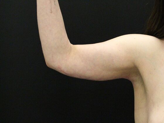 Arm Lift & Reduction: Case 14 - After