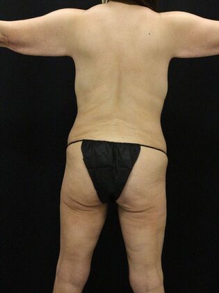 Liposuction: Case 63 - Before