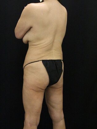 Liposuction: Case 63 - Before