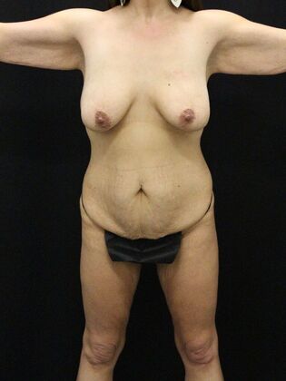 Tummy Tuck Case 76 - Before