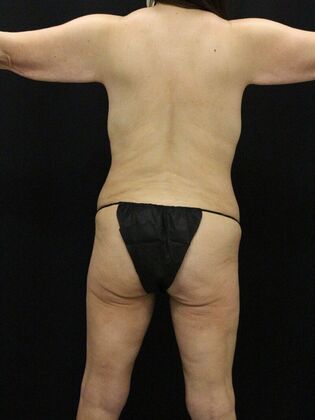 Tummy Tuck: Case 76 - Before