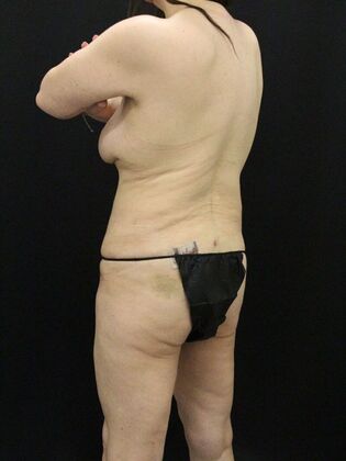 Tummy Tuck: Case 76 - After