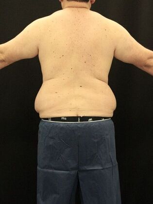 Liposuction Case 64 - Before