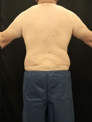 Liposuction Case 64 - After