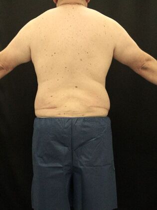 Body Lift Case 8 - After