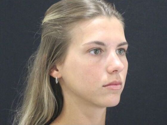 Injectables: Case 96 - Before