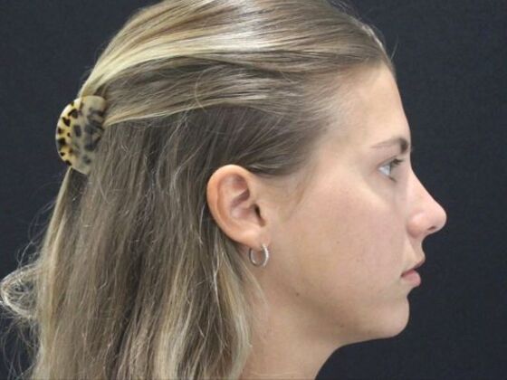 Injectables Case 96 - Before