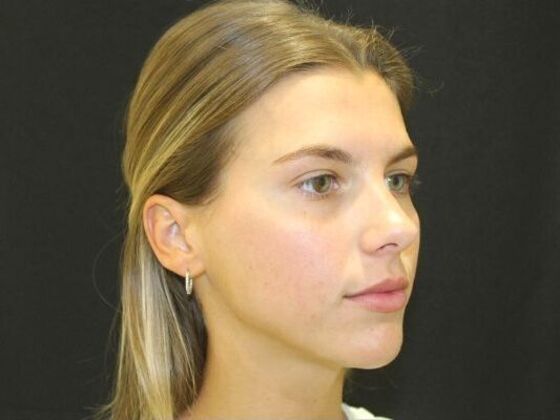 Injectables: Case 96 - After