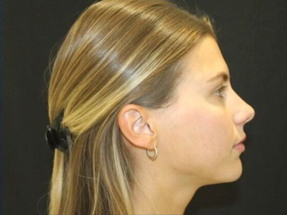 Injectables Case 96 - After