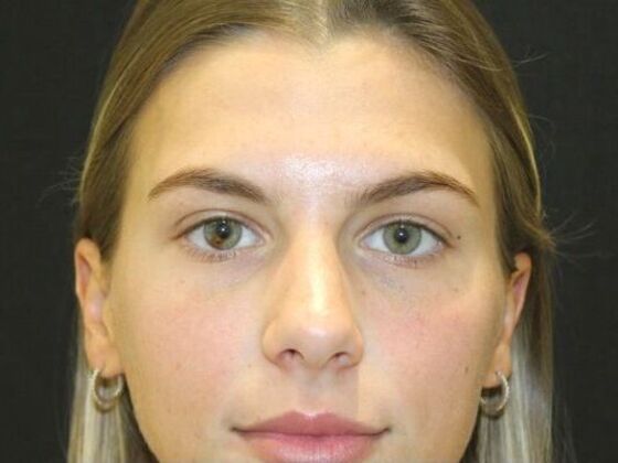 Injectables: Case 96 - After