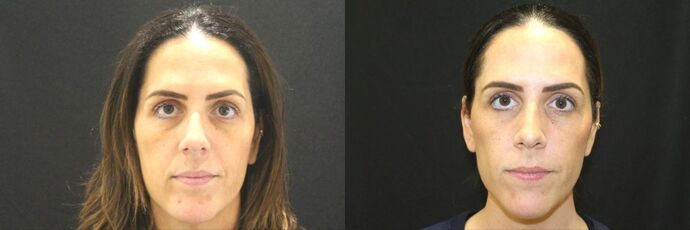 Injectables Case 97 - Before