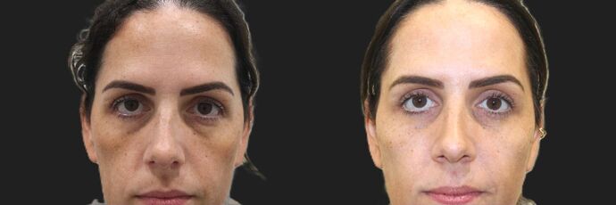 Injectables Case 97 - After