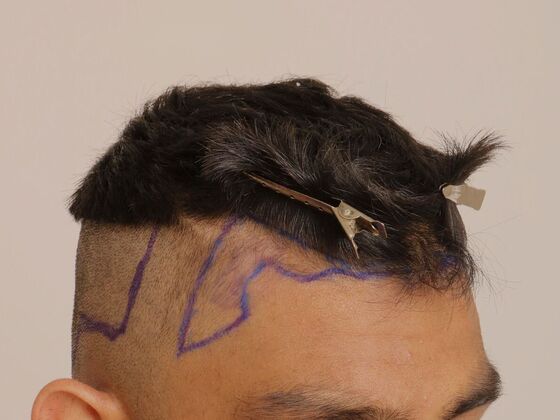 Hair Transplant - Male: Hairline FUE - Case 21 - Before FUE hair transplant