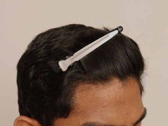 Hair Transplant - Male: Hairline FUE - Case 21 - After FUE hair transplant