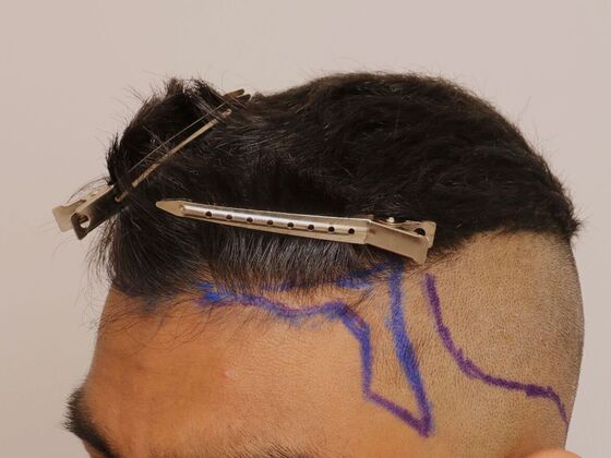 Hair Transplant - Male: Hairline FUE - Case 21 - Before FUE hair transplant