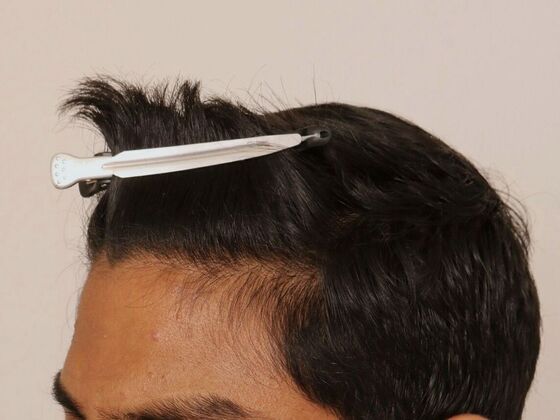 Hair Transplant - Male: Hairline FUE - Case 21 - After FUE hair transplant