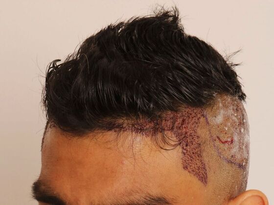 Hair Transplant - Male: Hairline FUE - Case 21 - Post-op FUE hair transplant