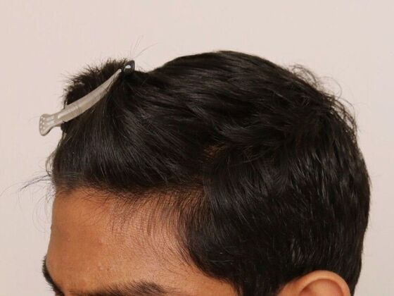 Hair Transplant - Male: Hairline FUE - Case 21 - After FUE hair transplant