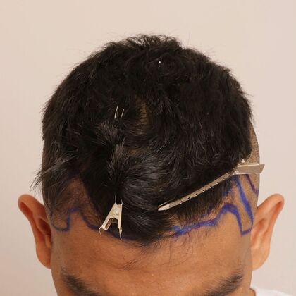 Hair Transplant - Male: Hairline FUE - Case 21 - Before FUE hair transplant