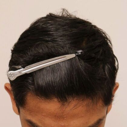 Hair Transplant - Male: Hairline FUE - Case 21 - After FUE hair transplant