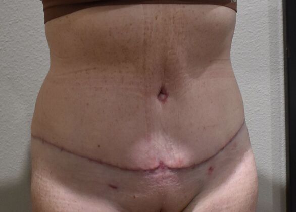 Tummy Tuck (Abdominoplasty): Case 545 - After