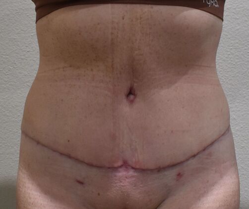 Tummy Tuck (Abdominoplasty) Case 545 - After