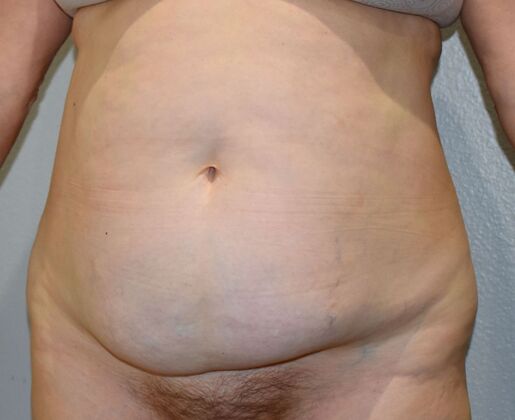 Tummy Tuck (Abdominoplasty): Case 547 - Before