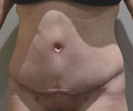 Tummy Tuck (Abdominoplasty): Case 547 - After
