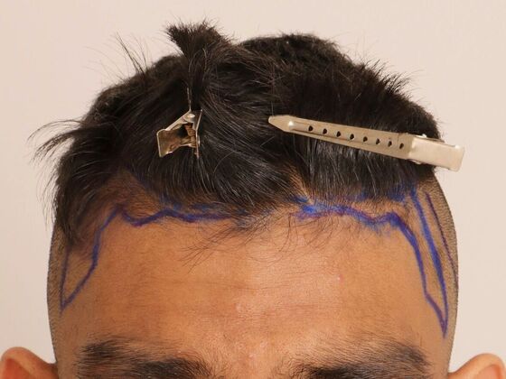 Male Before And After Hair Transplant Photos Hairline FUE ( 21 ) - Before