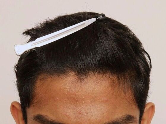 Male Before And After Hair Transplant Photos Hairline FUE ( 21 ) - After