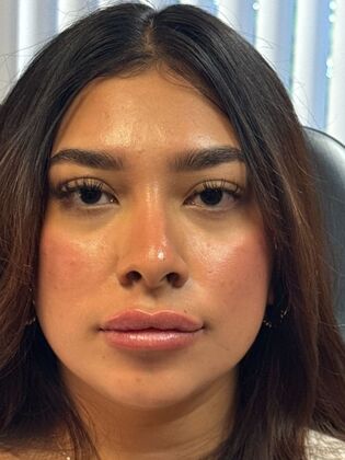 Cosmetic Injectables & Fillers*: Case 64 - After