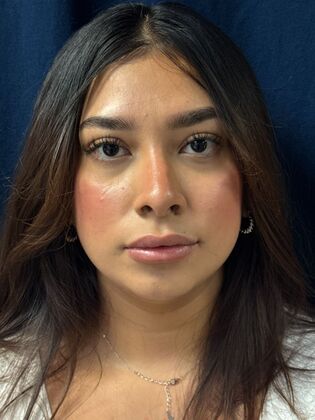 Cosmetic Injectables & Fillers*: Case 64 - Before