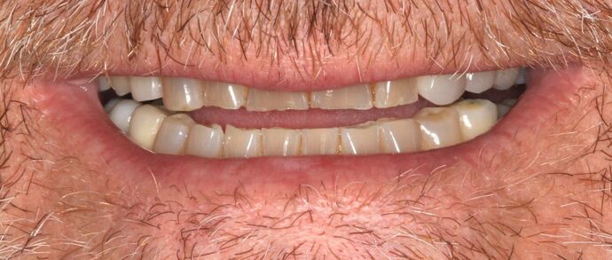 Full Mouth Reconstruction: Case 45 - Before