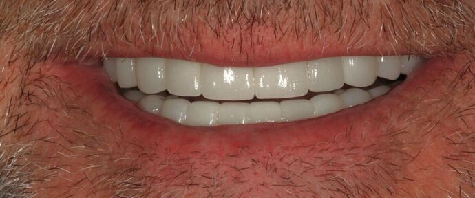 Full Mouth Reconstruction: Case 45 - After