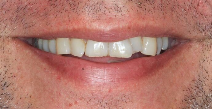 Full Mouth Reconstruction: Case 46 - Before